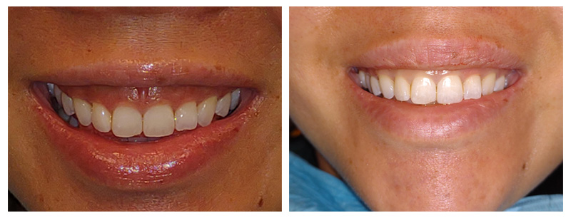 Tongue Tie case