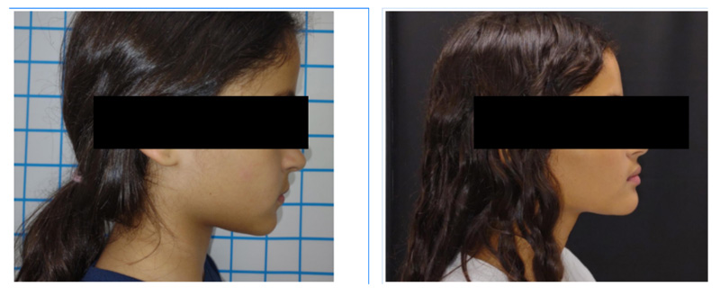 Clear Aligners Waltham