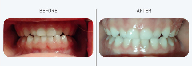 Clear Aligners Waltham